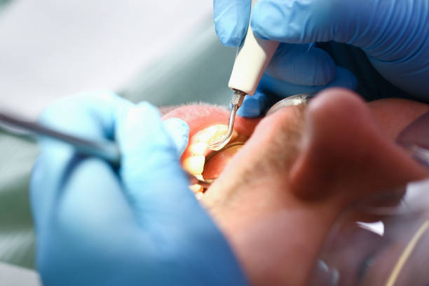 Best Emergency Treatment for Toothache in Bude, MS